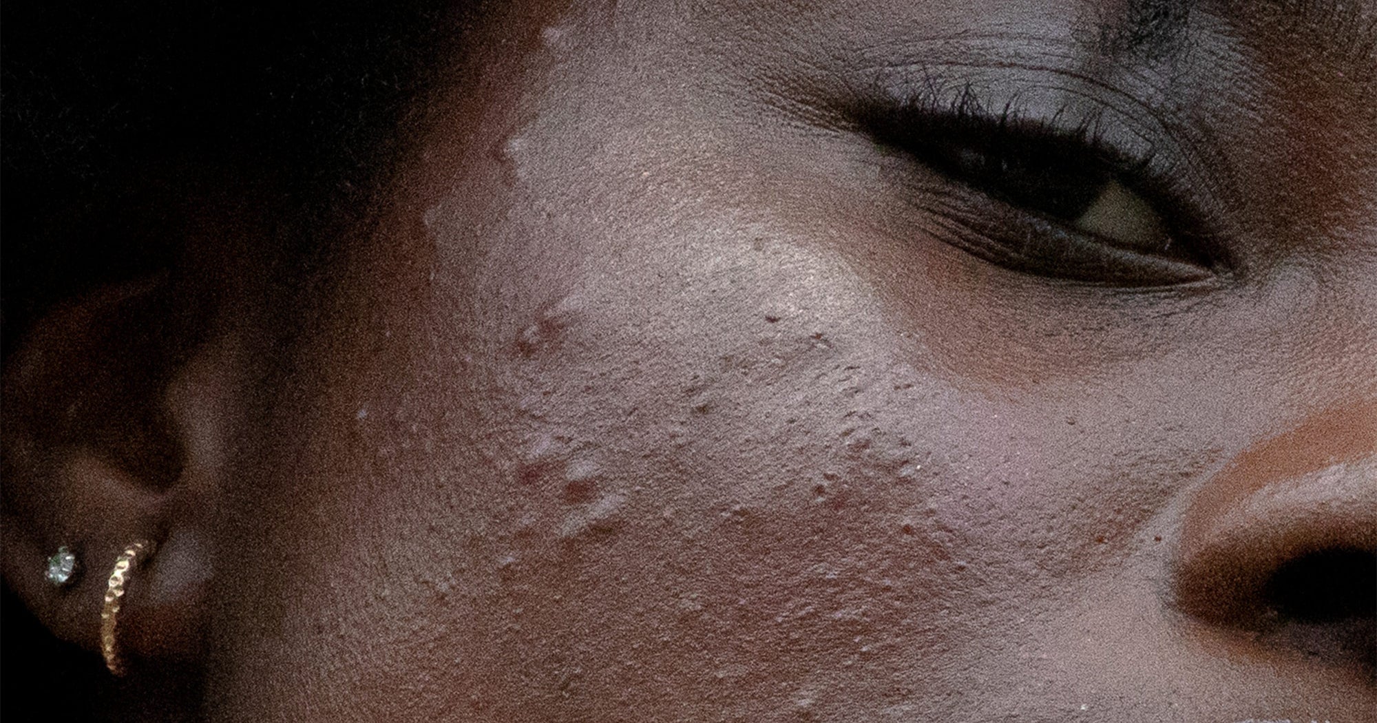Acne on Dark Skin: How to Treat Breakouts Without Making the Marks Worse
